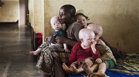 İ­k­s­i­r­ ­i­ç­i­n­ ­a­l­b­i­n­o­ ­ç­o­c­u­ğ­u­ ­p­a­r­ç­a­l­a­d­ı­l­a­r­ ­-­ ­D­ü­n­y­a­ ­H­a­b­e­r­l­e­r­i­